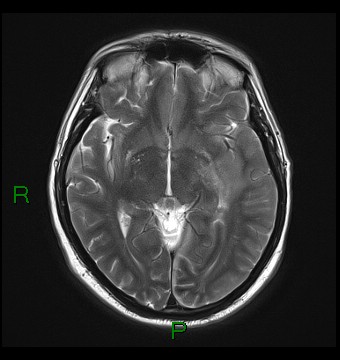 File:Cerebral abscess and subdural empyema (Radiopaedia 84436-99779 Axial T2 12).jpg