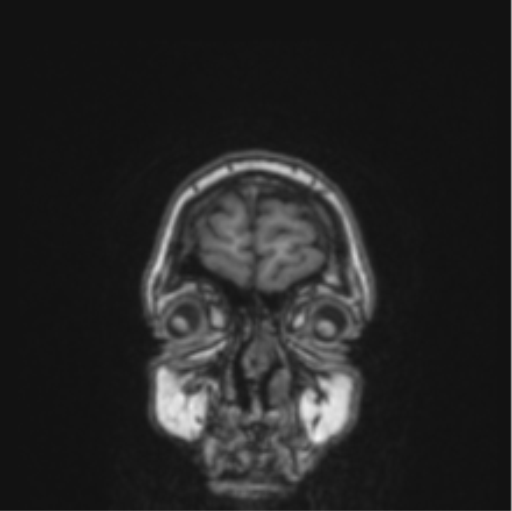 File:Cerebral abscess from pulmonary arteriovenous malformation (Radiopaedia 86275-102291 Coronal T1 83).png
