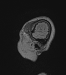 Cerebral abscess from pulmonary arteriovenous malformation (Radiopaedia 86275-102291 Sagittal FLAIR 68).png