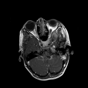 File:Cerebral abscess post cardiac surgery (Radiopaedia 27244-27420 Axial T1 C+ 3).jpg