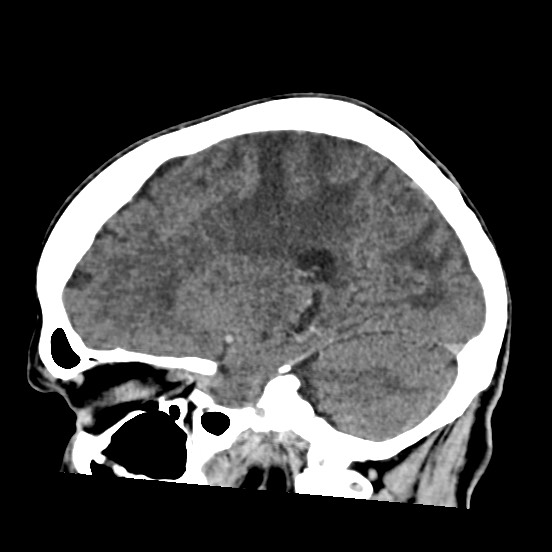 Cerebral amyloid angiopathy-related inflammation (Radiopaedia 74836-85848 C 23).jpg