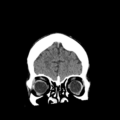 File:Cerebral amyloid angiopathy-related inflammation (Radiopaedia 74836-85848 Coronal non-contrast 13).jpg