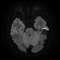 Cerebral amyloid angiopathy (Radiopaedia 28698-28978 Axial DWI 9).jpg