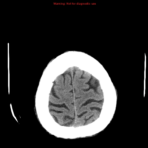 File:Cerebral and orbital tuberculomas (Radiopaedia 13308-13310 Axial non-contrast 25).jpg