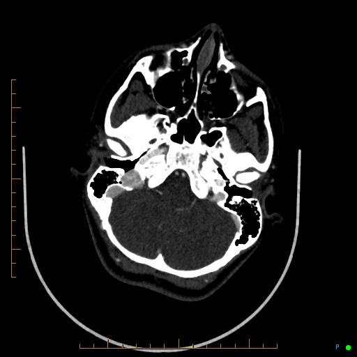 Cerebral arteriovenous malformation (AVM) (Radiopaedia 78162-90706 Axial CTA 70).jpg