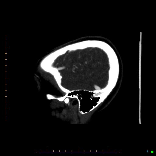 Cerebral arteriovenous malformation (AVM) (Radiopaedia 78162-90706 Sagittal CTA 13).jpg