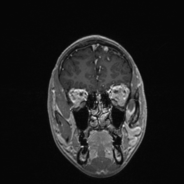 Cerebral arteriovenous malformation (Radiopaedia 30198-30813 F 15).jpg