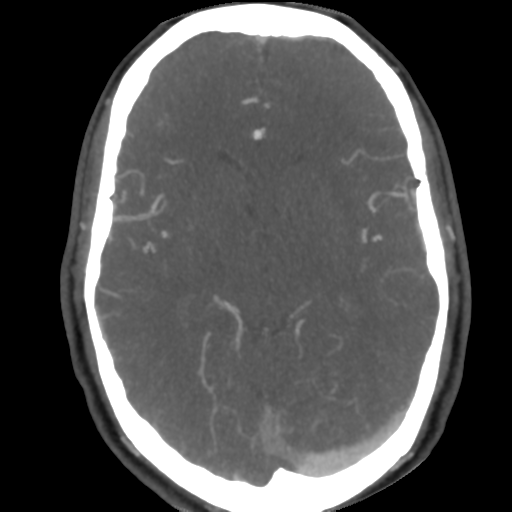 Cerebral arteriovenous malformation (Radiopaedia 39259-41505 AX CEREBRAL CTA 27).png