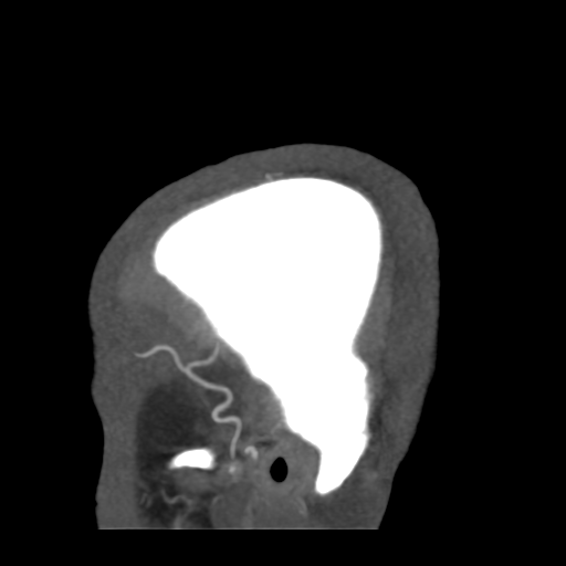 Cerebral arteriovenous malformation (Radiopaedia 39259-41505 Sagittal 5).png