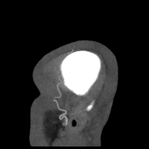 Cerebral arteriovenous malformation (Radiopaedia 39259-41505 Sagittal 59).png