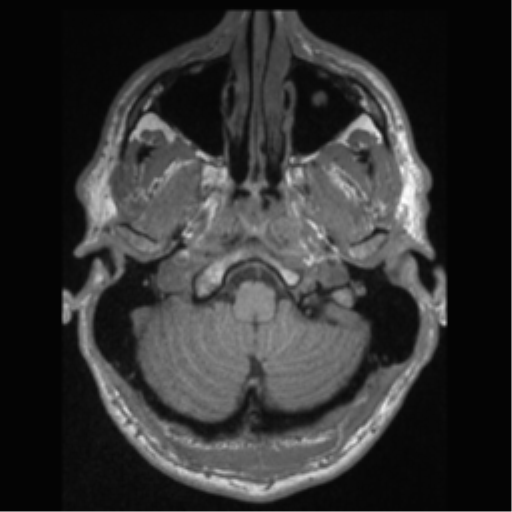File:Cerebral arteriovenous malformation (Radiopaedia 55798-62372 Axial T1 5).png