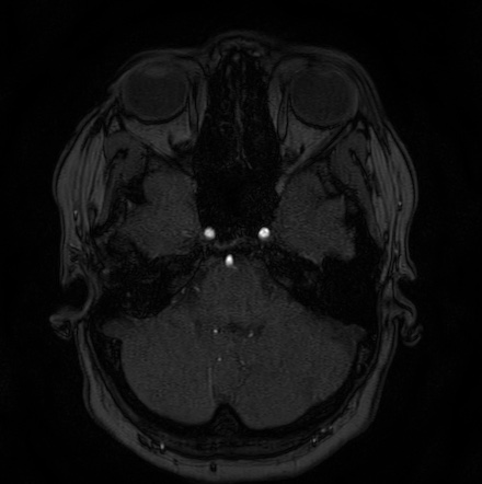 Cerebral arteriovenous malformation (Radiopaedia 74411-85654 Axial MRA 18).jpg