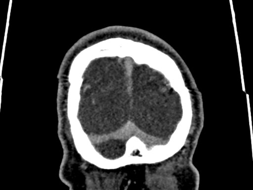 Cerebral arteriovenous malformation (Radiopaedia 78188-90746 Coronal C+ delayed 120).jpg