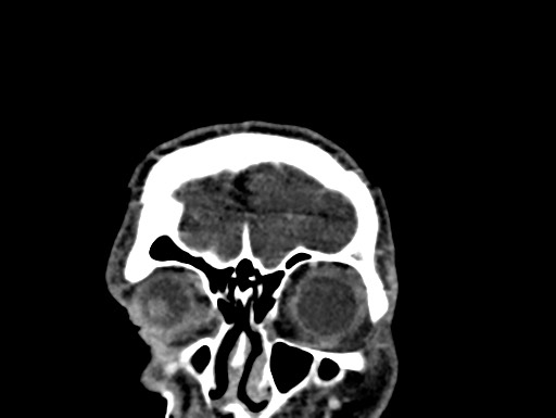 File:Cerebral arteriovenous malformation (Radiopaedia 78188-90746 Coronal C+ delayed 3).jpg