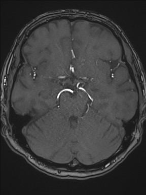 Cerebral arteriovenous malformation (Radiopaedia 84015-99245 Axial TOF 101).jpg