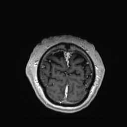Cerebral arteriovenous malformation (Radiopaedia 84015-99245 Coronal T1 C+ 158).jpg