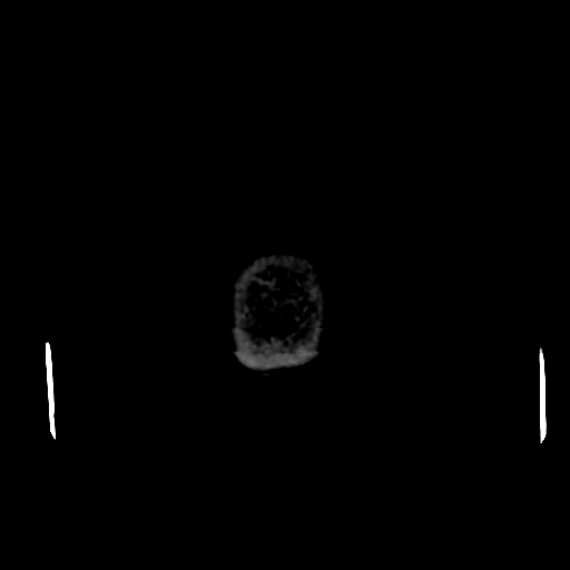 Cerebral arteriovenous malformation (Spetzler-Martin grade 2) (Radiopaedia 41262-44076 Axial non-contrast 57).png
