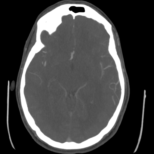 Cerebral arteriovenous malformation (Spetzler-Martin grade 2) (Radiopaedia 41262-44076 E 25).png