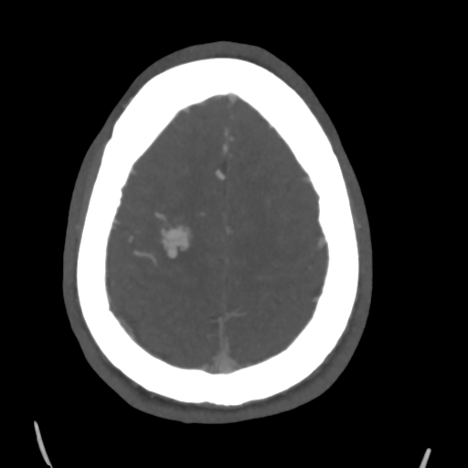 Cerebral arteriovenous malformation (Spetzler-Martin grade 2) (Radiopaedia 41262-44076 E 44).png