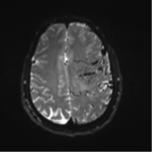 File:Cerebral arteriovenous malformation - huge (Radiopaedia 35734-37272 Axial DWI 17).png