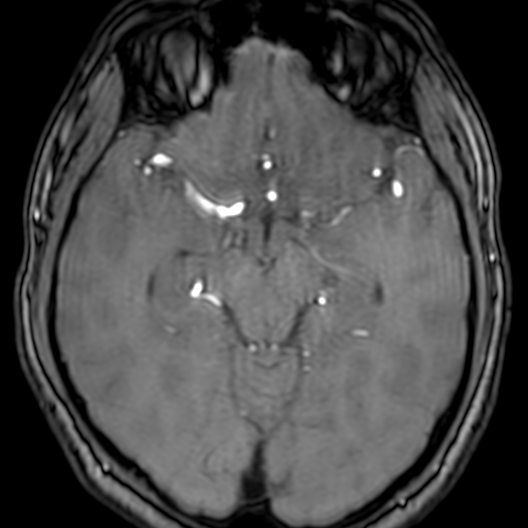 Cerebral arteriovenous malformation at posterior body of corpus callosum (Radiopaedia 74111-84925 Axial MRA 85).jpg