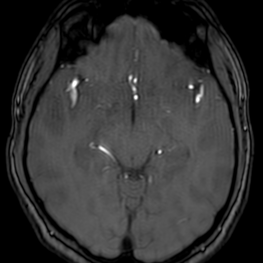 Cerebral arteriovenous malformation at posterior body of corpus callosum (Radiopaedia 74111-84925 Axial MRA 90).jpg