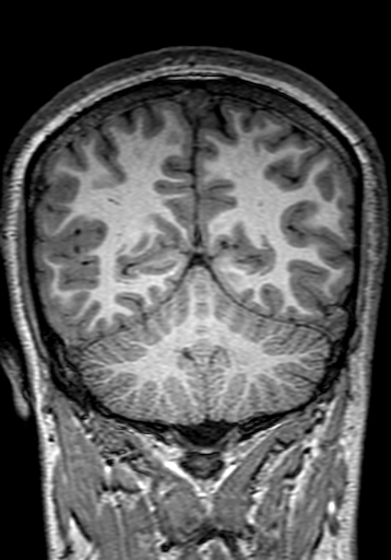 File:Cerebral arteriovenous malformation at posterior body of corpus callosum (Radiopaedia 74111-84925 Coronal T1 254).jpg