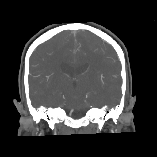 Cerebral arteriovenous malformation with lobar hemorrhage (Radiopaedia 35598-57216 C 52).jpg
