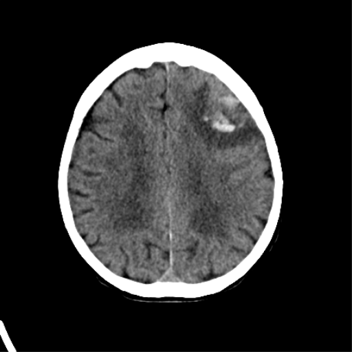 File:Cerebral arteriovenous malformation with lobar hemorrhage (Radiopaedia 44725-48510 Axial non-contrast 28).png