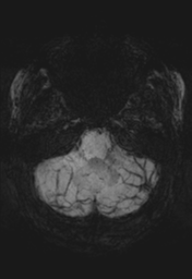 File:Cerebral cavernoma and development venous anomaly (Radiopaedia 37603-39482 Axial SWI MIP 8).png