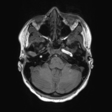Cerebral cavernous venous malformation (Radiopaedia 70008-80021 Axial T1 14).jpg
