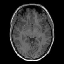 Cerebral cavernous venous malformation (Radiopaedia 70008-80021 Axial T1 32).jpg