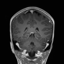 Cerebral cavernous venous malformation (Radiopaedia 70008-80021 Coronal T1 C+ 23).jpg