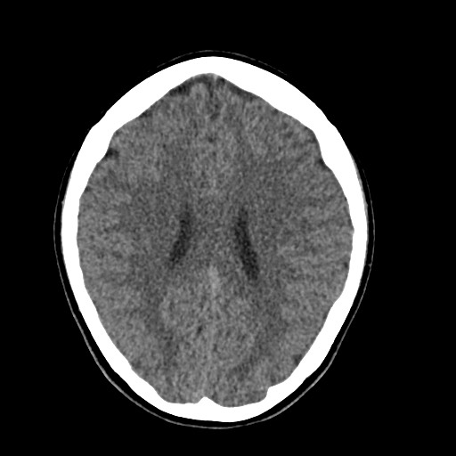 Cerebral cavernous venous malformation (Radiopaedia 70008-80022 Axial non-contrast 33).jpg