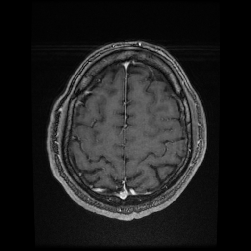 Cerebral cavernous venous malformation (Zabramski type II) (Radiopaedia 85511-101198 Axial T1 C+ fat sat 22).jpg