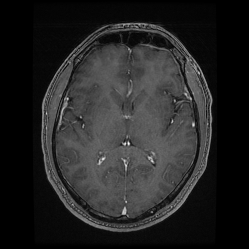 Cerebral cavernous venous malformation (Zabramski type II) (Radiopaedia 85511-101198 Axial T1 C+ fat sat 43).jpg