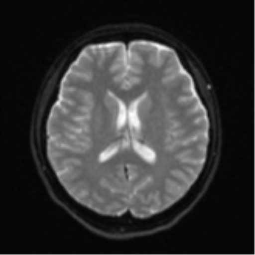 Cerebral cavernous venous malformations (Radiopaedia 48117-52946 Axial DWI 16).png