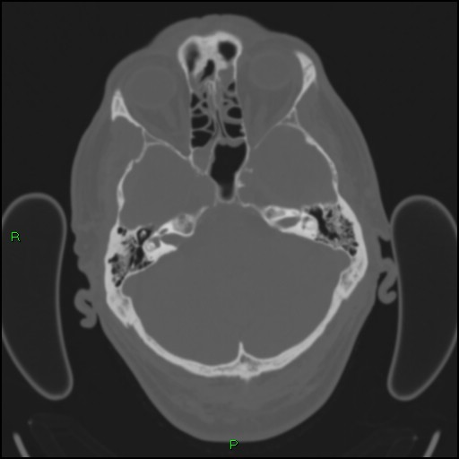 Cerebral contusions (Radiopaedia 33868-35039 Axial bone window 48).jpg