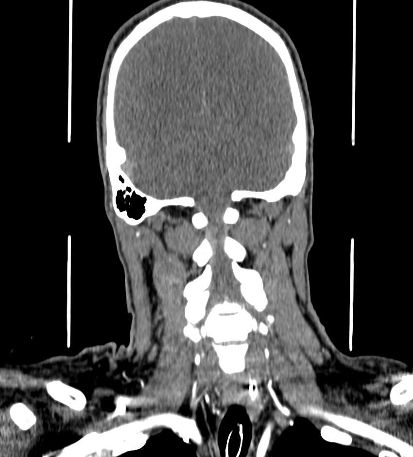 Cerebral edema in an overdose patient (Radiopaedia 72005-82539 B 124).jpg