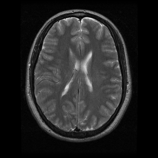 File:Cerebral hemorrhage secondary to arteriovenous malformation (Radiopaedia 33497-34572 Axial T2 15).png