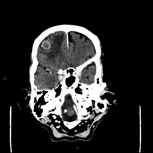 Cerebral metastases - breast primary (Radiopaedia 77653-89857 Axial C+ delayed 28).jpg