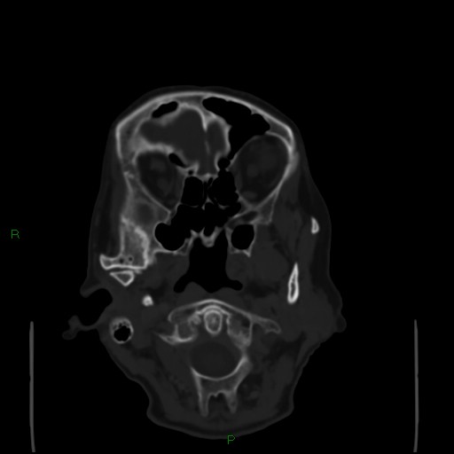 File:Cerebral metastases - breast primary (Radiopaedia 77653-89857 Axial bone window 13).jpg