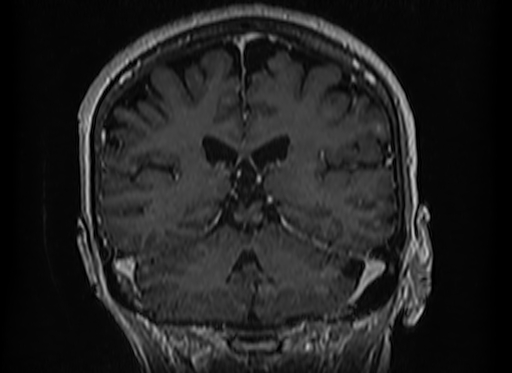 Cerebral metastases from lung cancer with amyloid angiopathy and cerebellopontine angle meningioma (Radiopaedia 74306-85191 Coronal T1 C+ 38).jpg