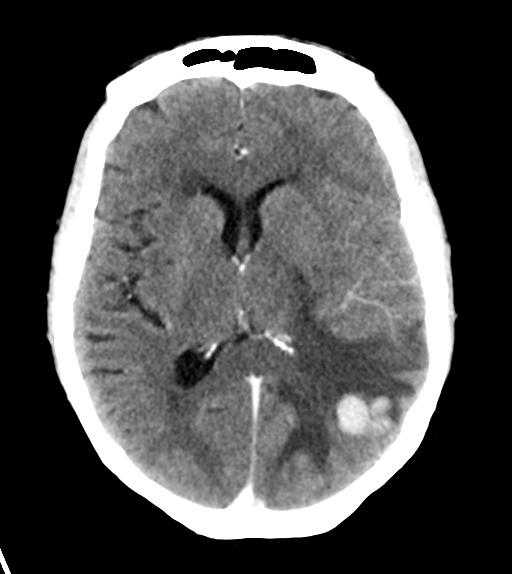 File:Cerebral metastasis (Radiopaedia 46744-51260 Axial C+ delayed 16).png