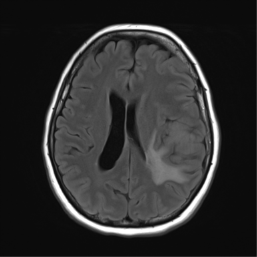 File:Cerebral metastasis mimicking glioblastoma (Radiopaedia 69155-78937 Axial FLAIR 21).png