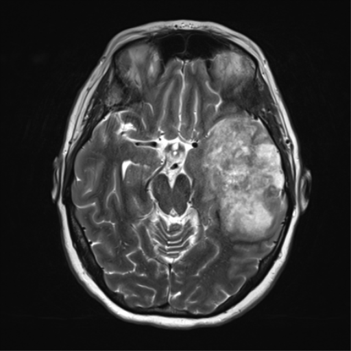 File:Cerebral metastasis mimicking glioblastoma (Radiopaedia 69155-78937 Axial T2 16).png