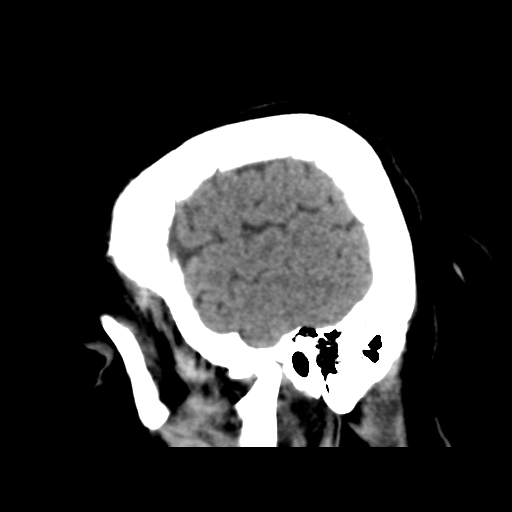 File:Cerebral metastasis to basal ganglia (Radiopaedia 81568-95412 E 50).png