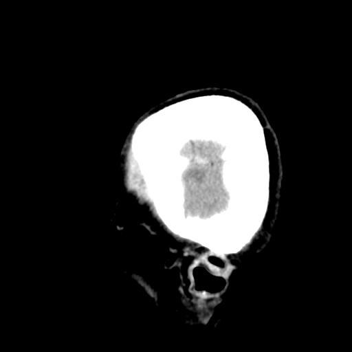 Cerebral metastasis to basal ganglia (Radiopaedia 81568-95412 Sagittal C+ delayed 7).png