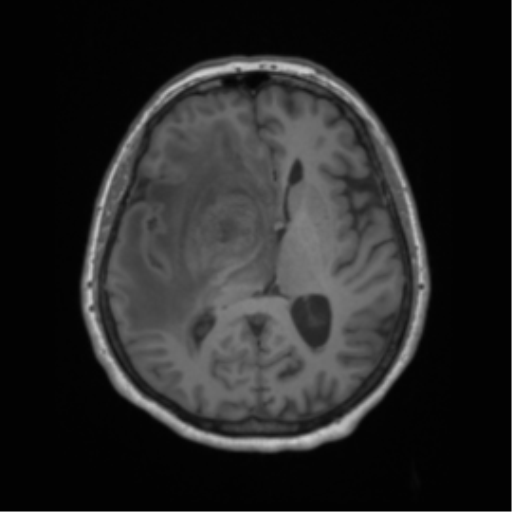 Cerebral metastasis to basal ganglia (Radiopaedia 81568-95413 Axial T1 37).png