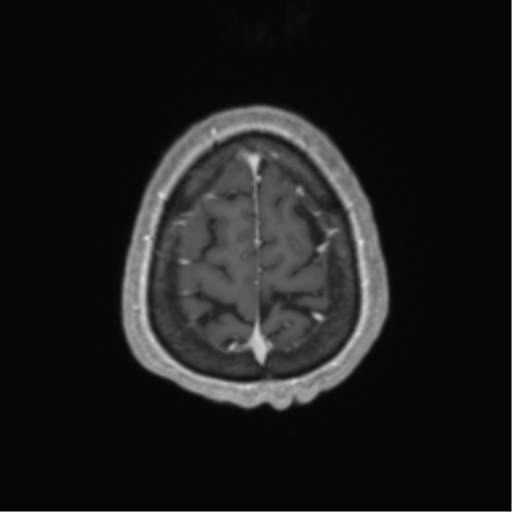 Cerebral metastasis to basal ganglia (Radiopaedia 81568-95413 Axial T1 C+ 67).png
